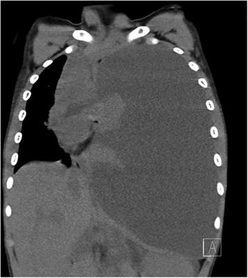 Case Report: Pancreaticopleural fistula with an atypical tract in a child with bulging chest